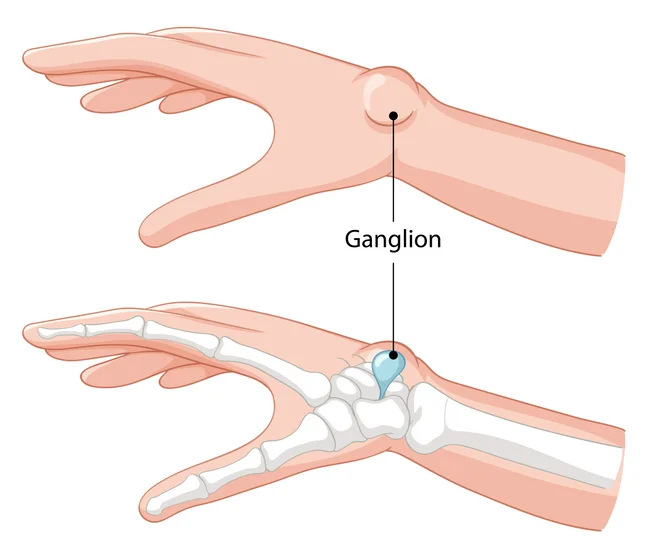Safe and Proven Ganglion Cyst Treatment for Quick Recovery